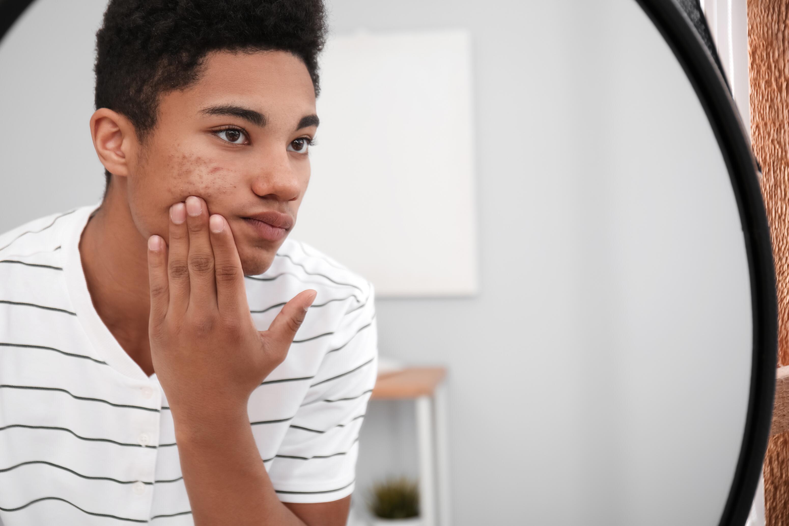 Akne bei Jugendlichen: Ursachen, Behandlungen und dermatologische Beratung